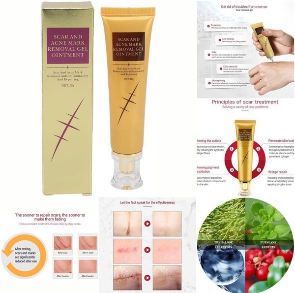 30g Scar d Acne Mark Removal Gel Ointment -